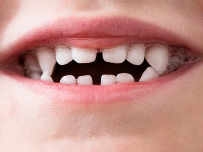 Billede viser et tandsæt med et ikke korrekt sammenbid af fortænderne, et "suttebid"