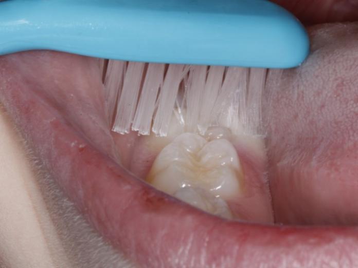 Billedet viser en tand, der bliver børstet på tværvs