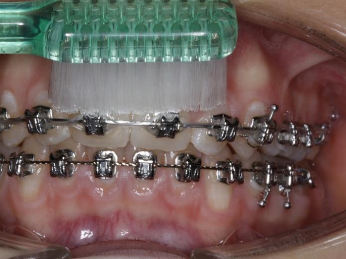 Tandbørstning af tænder med bøjle (brackets) på. Børstning af den øverste del af tanden, der ikke er dækket af bøjle (brackets)