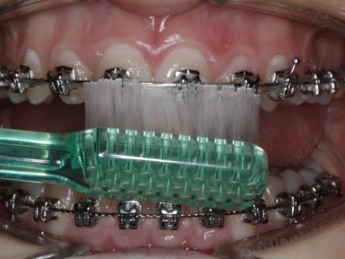 Tandbørstning med bøjle. Tandbørstning af den nederste den af tanden.