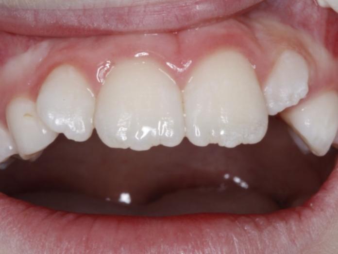 Billedet viser sunde tænder. Tændernes yderste lag, emaljen, ses med en fin og sund overflade, struktur og farve
