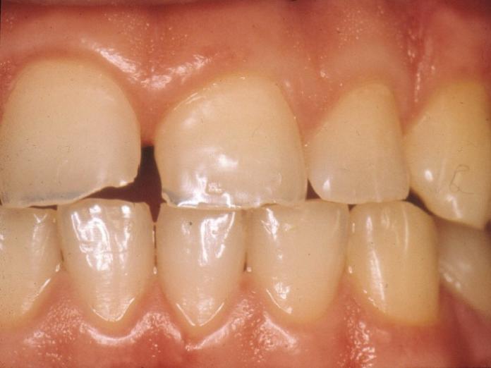 Billedet viser tænder med syreskader. Tandens yderst lag, emaljen, er blevet ætset af, og nogle steder er der knækket tand af på grund af ætsning og slid