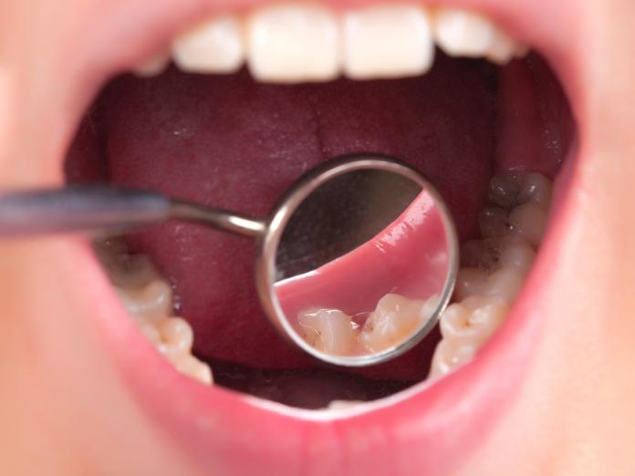 En åben mund, hvor der bliver kigget på tænderne med et lille spejl